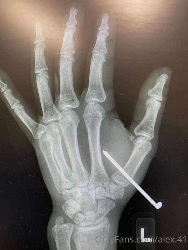 Turns out I have great aim with a nail gun, looks like I get..