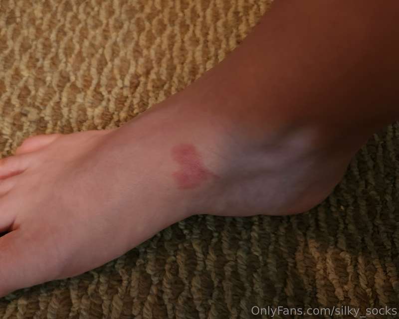 I got this silly little bruise somehow! 
Tomorrow everything..