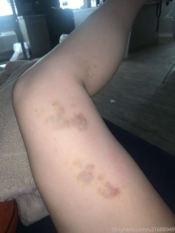 bruising from trying to learn how dance on that damn pole ):..