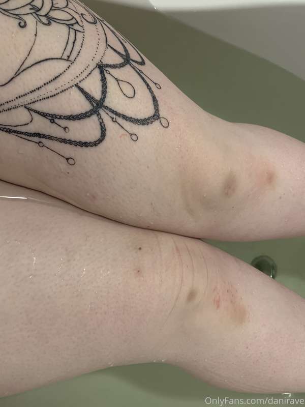 One of my favorite bruises 👅