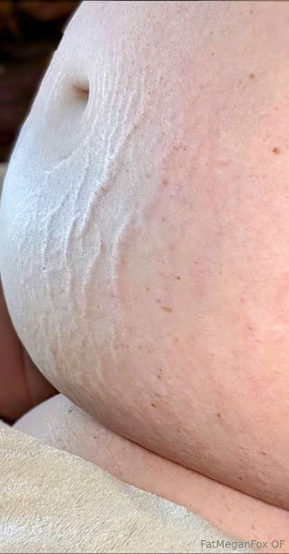 I bloated big time last night and sheesh my stretchmarks are..