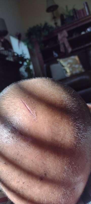 This past thanksgiving I sprained my neck and shoulder blade..