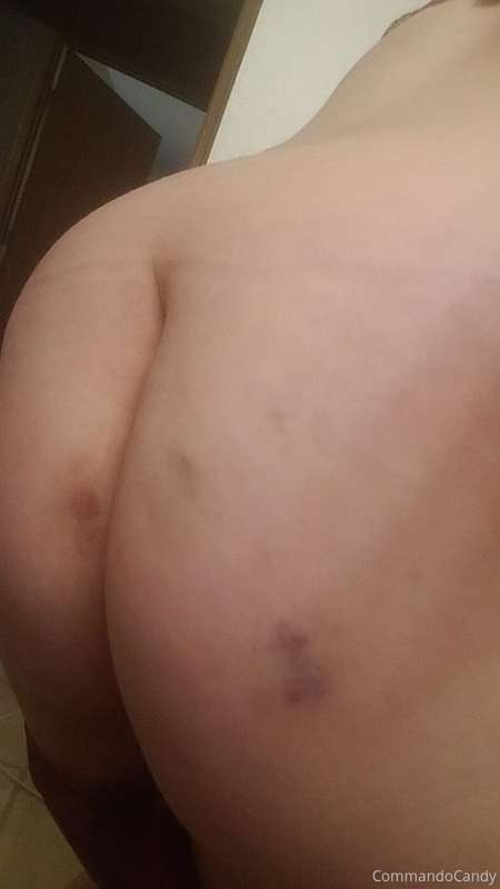 Sometimes... bruises happen 🥵🥵🍑🍑 | commandocandy Onlyfans Picture