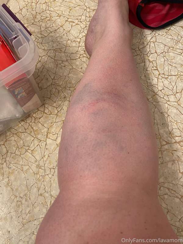 Was in a pretty bad accident this week and as a result, I am..