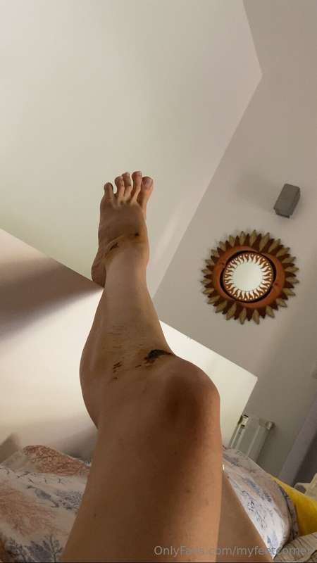 Quick update on my recovery… my foot and knee are still maul..