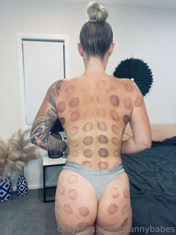 Does anyone else like cupping therapy ?? 😝