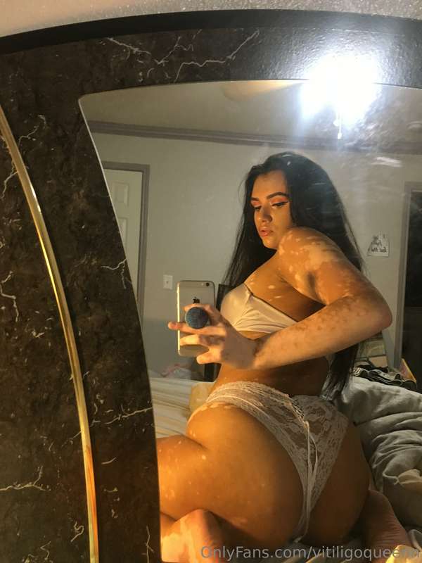 vitiligoqueenn