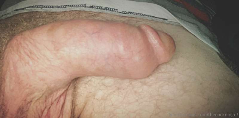 Day 37 post op 2nd procedure: almost healed completely. Flac..